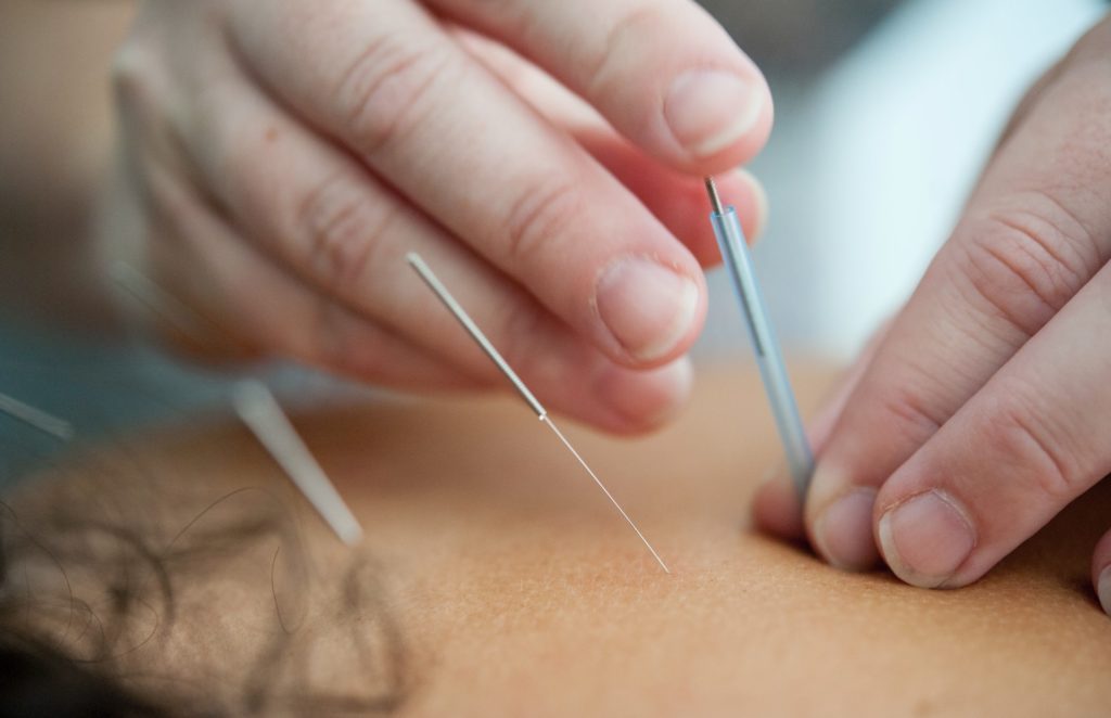 Close up photo of skin with acupuncture needle inserted. A second needle is being inserted but still in the guiding tube with one hand holding the tube and another at the head of the needle.